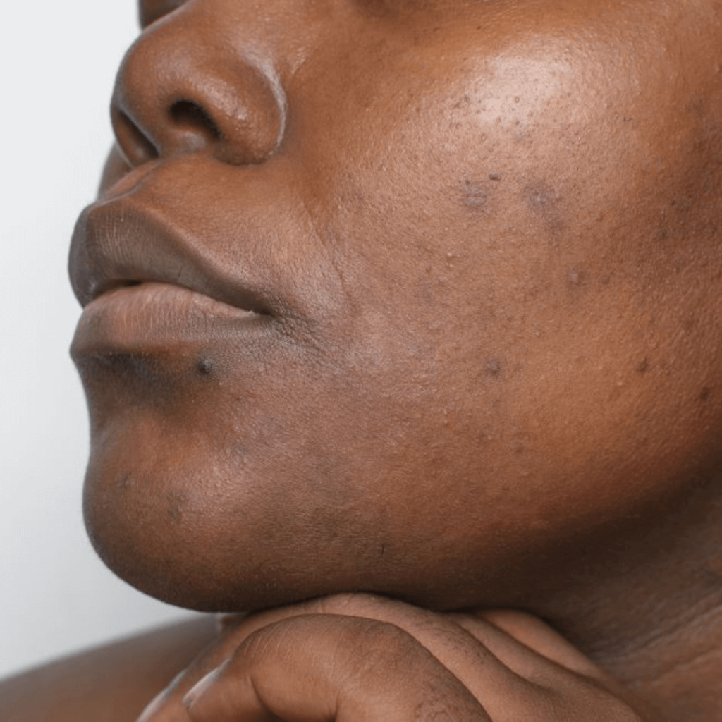 black woman with hyperpigmentation on face