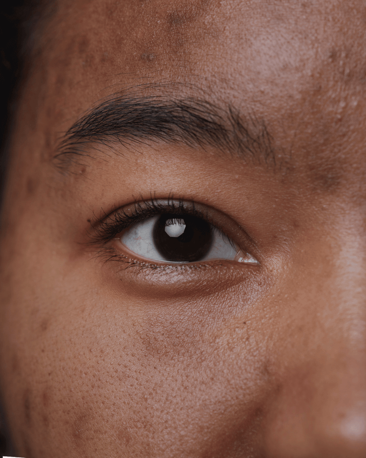 Very closeup of woman with hyperpigmentation