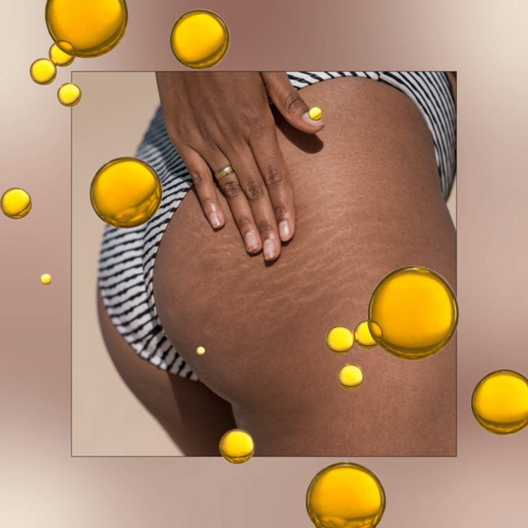 Woman touching her hips with stretch marks